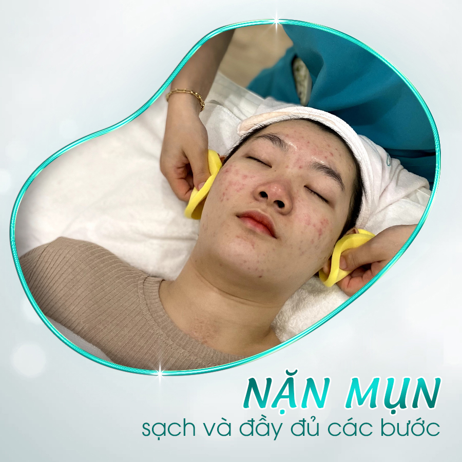 Dịch vụ nặn mụn chuyên sâu